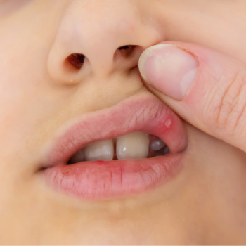 Aphtes buccaux : Soulagement rapide et conseils chez Dentiste Midoun