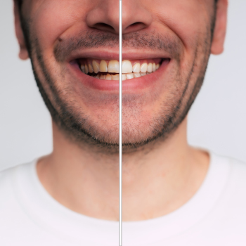 Blanchiment dentaire : Un sourire éclatant chez Dentiste Midoun