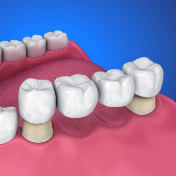 Bridges dentaires : Remplacez vos dents manquantes chez Dentiste Midoun