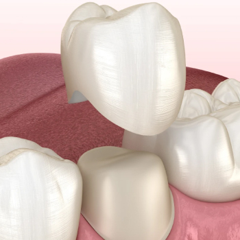 Couronnes dentaires : Protégez et renforcez vos dents chez Dentiste Midoun