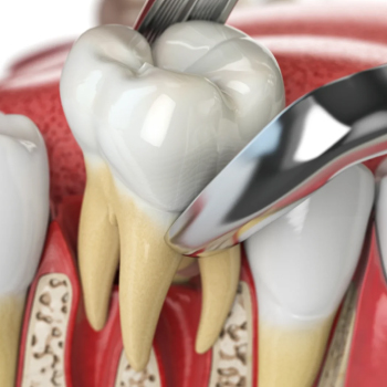 Extraction dentaire simple : Retrait efficace et sécurisé – Dentiste Midoun