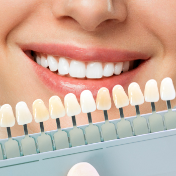 Facettes céramiques : Offrez un nouveau sourire à votre visage – Dentiste Midoun