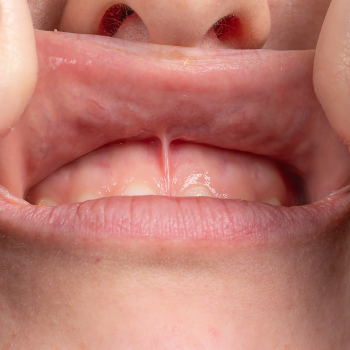 Frénectomie : Correction et confort chez Dentiste Midoun