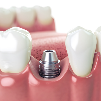 Qu’est-ce qu’un implant dentaire ? Comprendre la solution moderne pour remplacer une dent – Dentiste Midoun