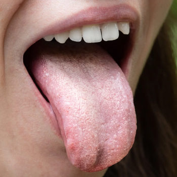 Mycoses buccales : Traiter efficacement les infections fongiques – Dentiste Midoun