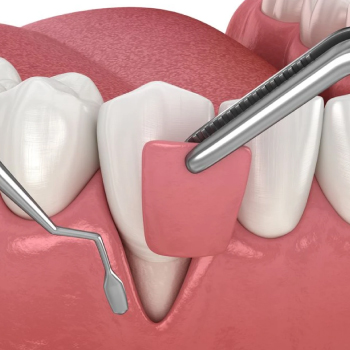 Résection apicale : Traitement spécialisé chez Dentiste Midoun