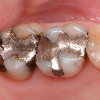 Restauration par amalgame (plombage) : Solution durable pour traiter les caries – Dentiste Midoun