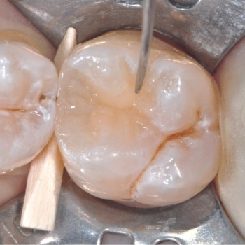 Scellement de sillons : Prévention des caries dès le plus jeune âge – Dentiste Midoun