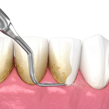 Surfaçage radiculaire : Nettoyage en profondeur contre les maladies des gencives – Dentiste Midoun