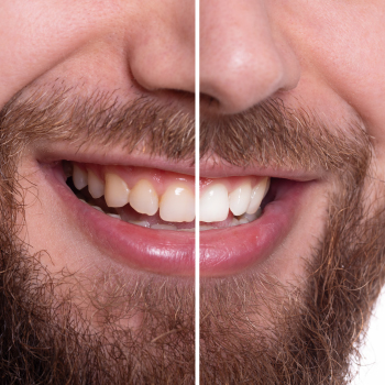 Blanchiment des dents : retrouvez un sourire éclatant et naturel