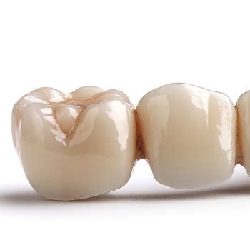 Bridge dentaire : une solution fiable pour remplacer une ou plusieurs dents manquantes