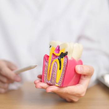 Caries dentaires : Tout savoir sur le traitement et la prévention