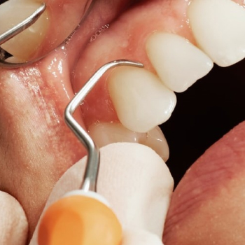 Détartrage dentaire : pour une bouche saine et un sourire éclatant