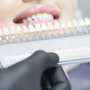 Les facettes céramiques : un sourire parfait en toute simplicité