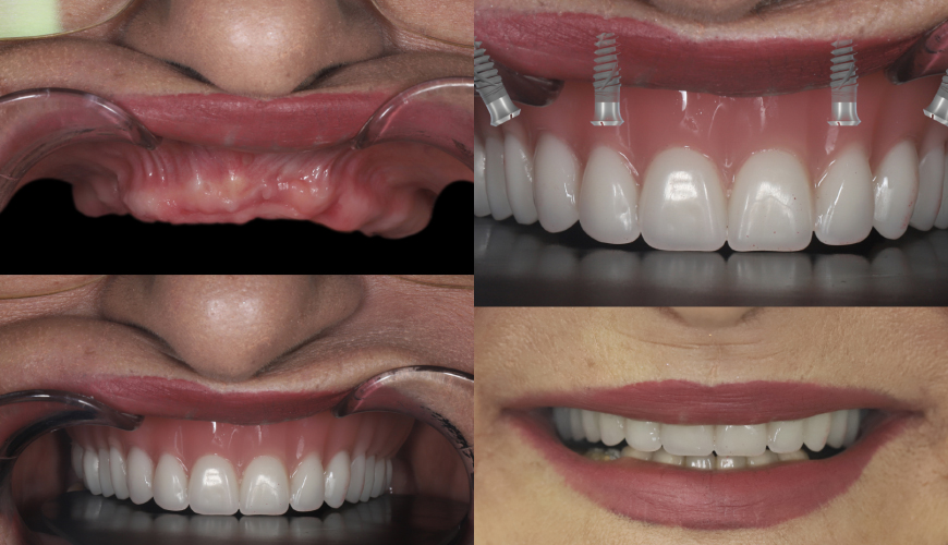 Renaissance par Implants Dentaires - Cabinet Dentaire Midoun Djerba – Dr Jaajaa Jamila