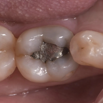 Restaurations dentaires par amalgame : une solution durable contre les caries